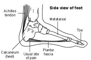 Plantar Fasciitis